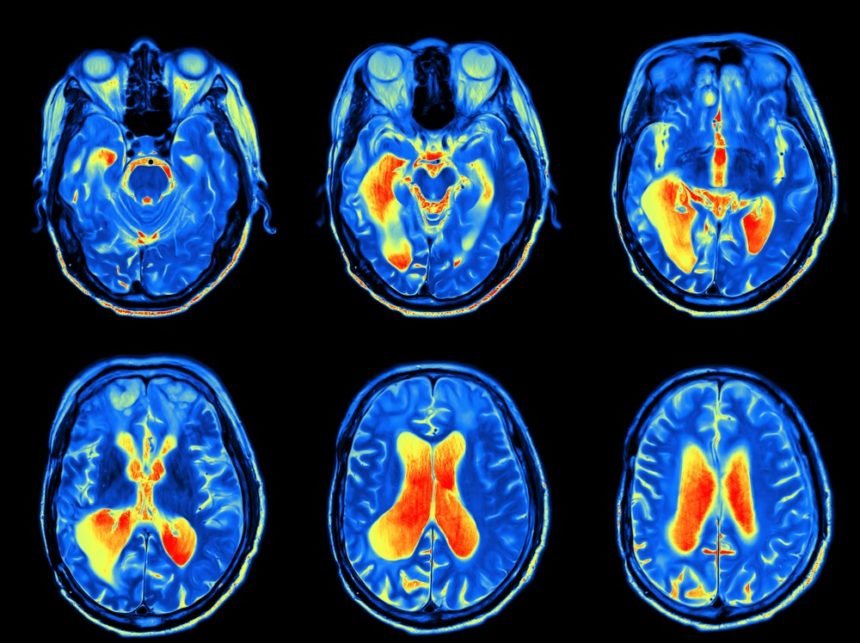 FMRI Functional Magnetic Resonance Imaging MRI 